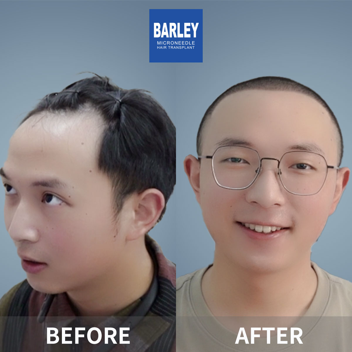 男性髮際線移植